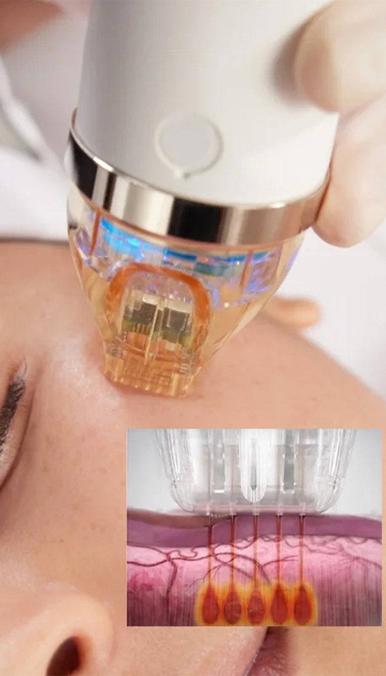 secret-rf-microneedling