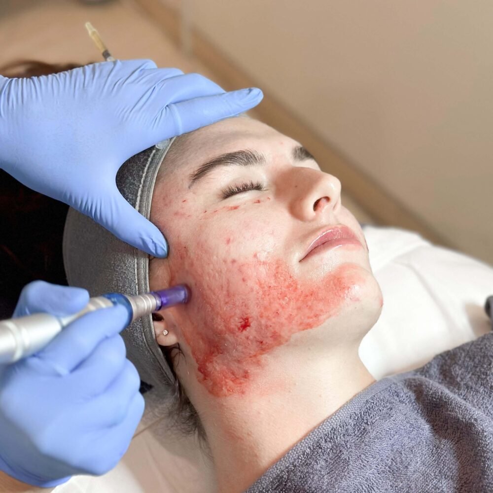 PRP Treatment at Holistic Spa & Laser Clinic